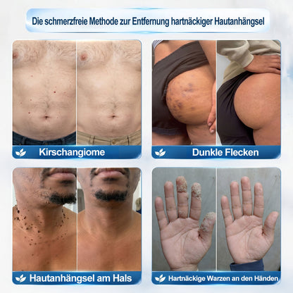 Offizieller Markenstore |🎀🎀𝑷𝑖𝒄𝐝𝐨® 7-𝑻𝒂𝒈𝒆 𝑯𝒂𝒖𝒕𝒂𝒏𝒉ä𝒏𝒈𝒔𝒆𝒍- & 𝑭𝒍𝒆𝒄𝒌𝒆𝒏𝒆𝒏𝒕𝒇𝒆𝒓𝒏𝒆𝒓(Schmerzfreier Rollerball – Keine Narbenbildung)🚀
